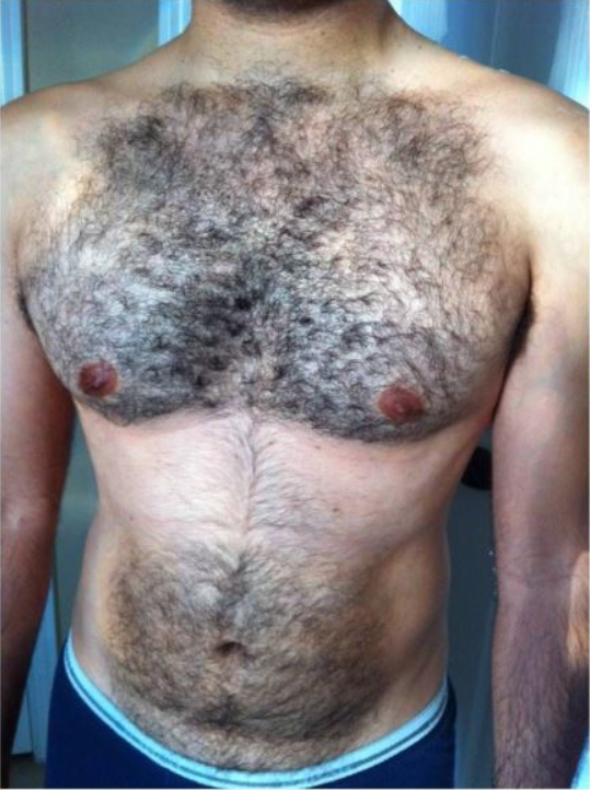 Laser Hair Removal for Men Ahmedabad | Male Laser Hair Removal